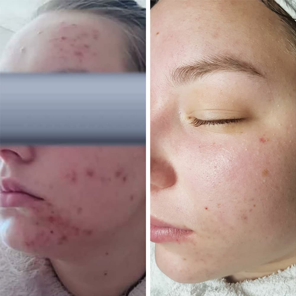 Результат Skin Refiner Fluid REVIDERM.Україна REVIDERM.ua